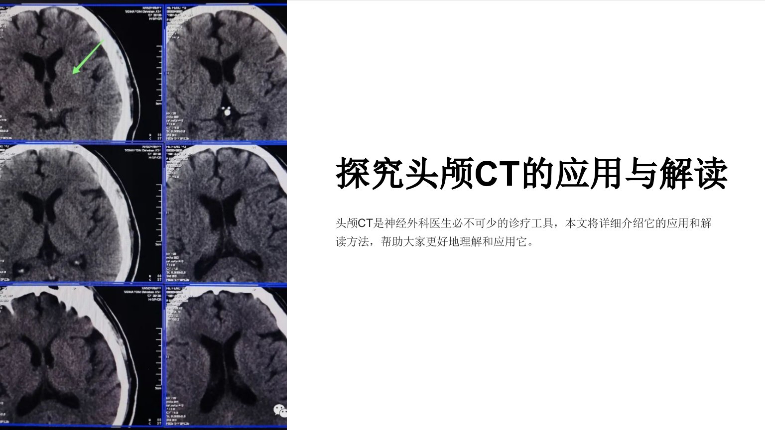 头颅ct基本知识及神经外科常见疾病ct读片课件