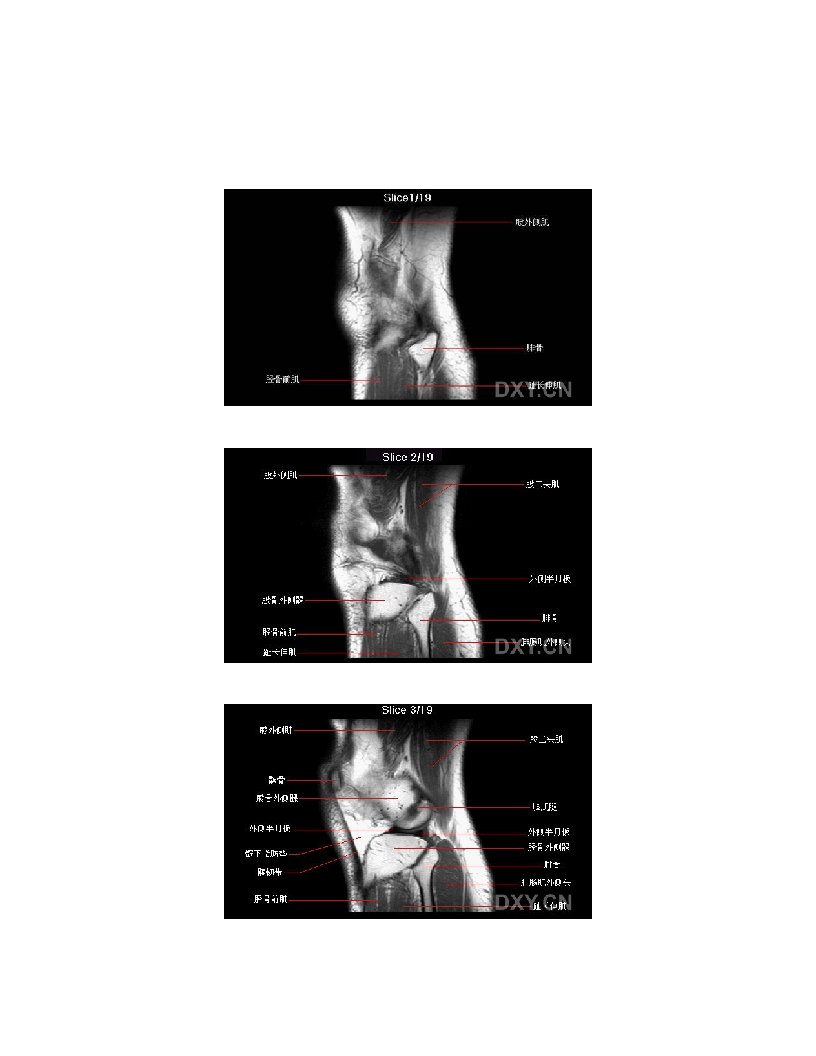 膝关节矢状位MRI解剖图谱
