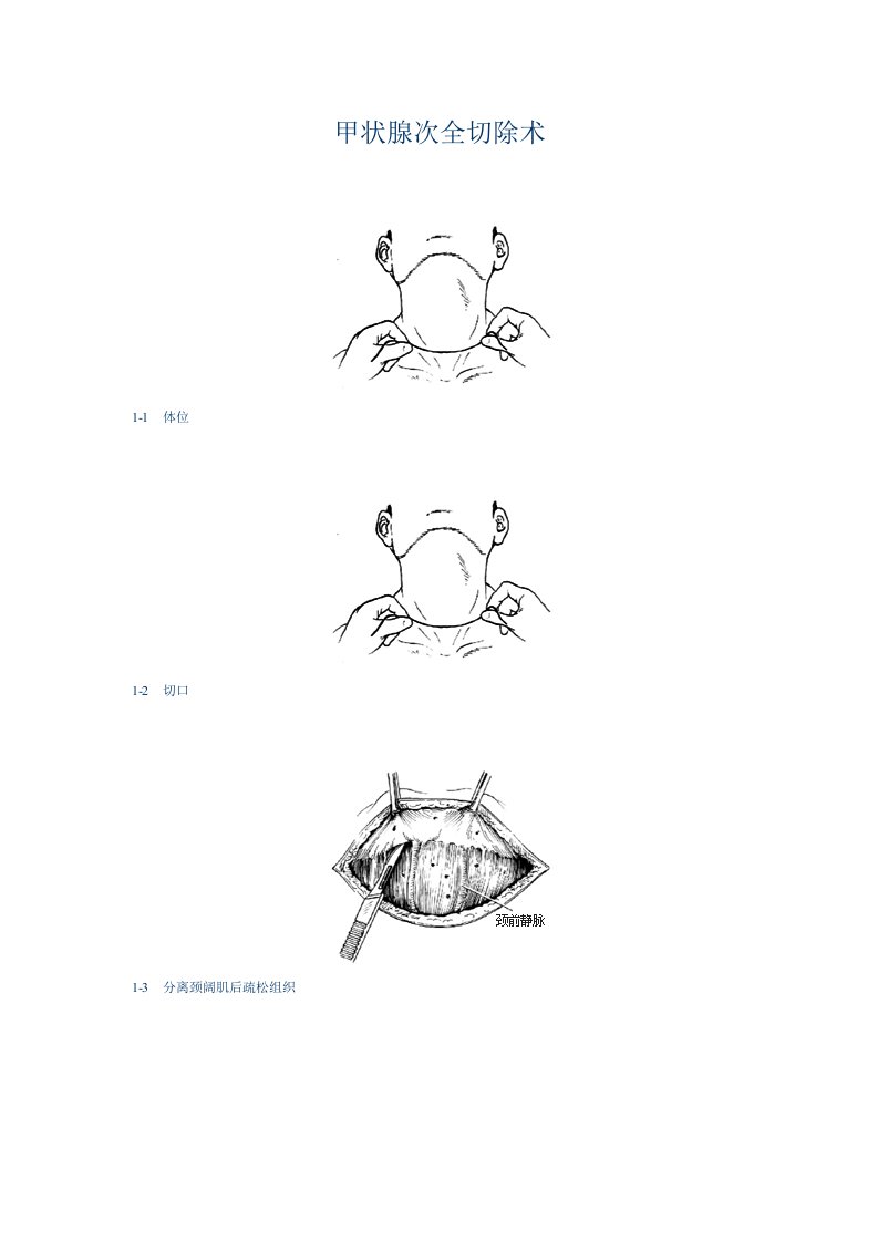 甲状腺次全切除术手术图谱